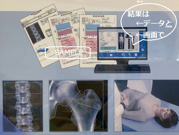 骨密度測定装置ホライゾンでの検査結果